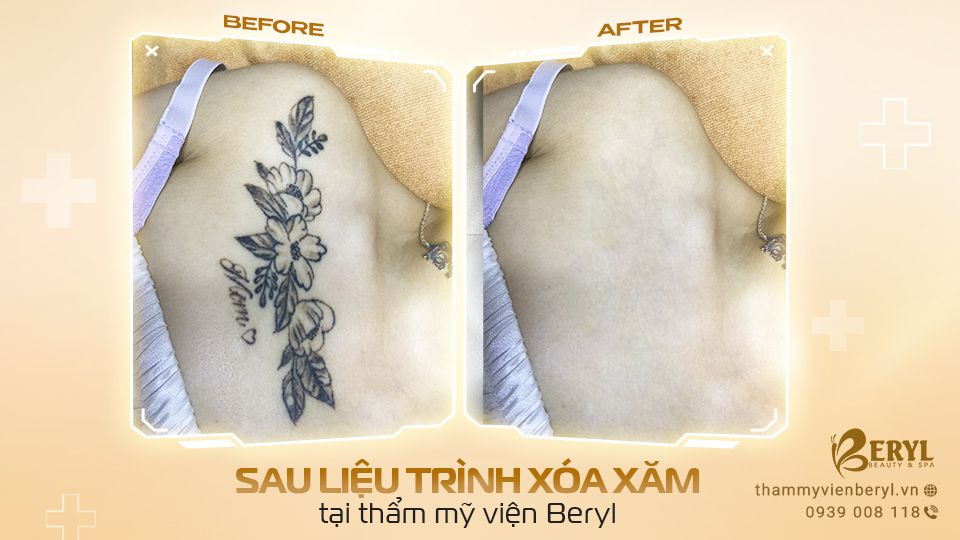 Hình ảnh trước và sau xóa xăm tại Beryl