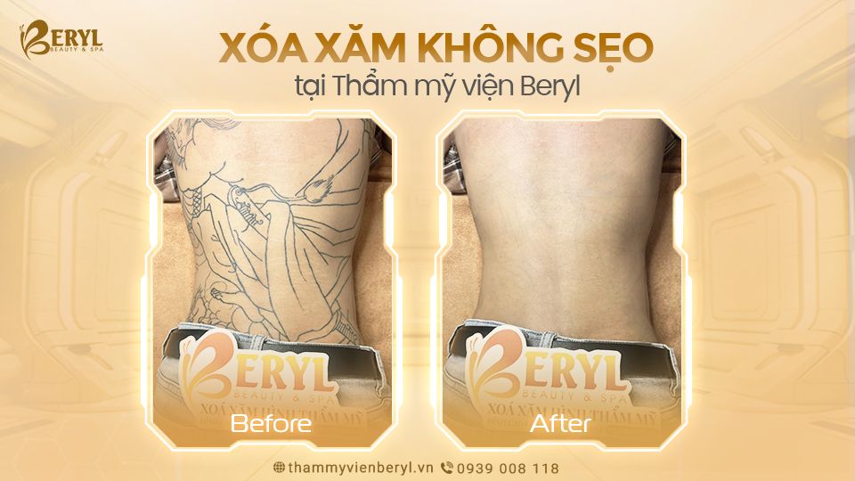 Hình ảnh trước và sau khi xóa xăm tại Beryl