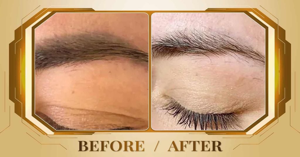 Hình ảnh trước và sau khi xóa xăm lông mày tại Thẩm Mỹ Viện Beryl