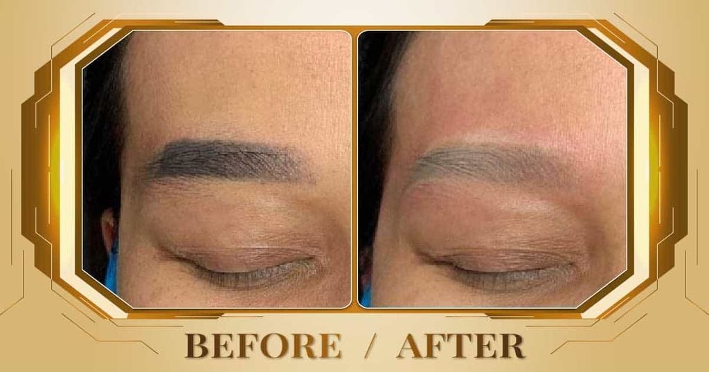 Hình ảnh trước và sau khi xóa xăm lông mày tại Thẩm Mỹ Viện Beryl
