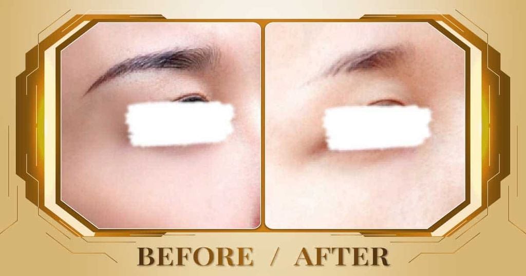 Hình ảnh trước và sau khi xóa xăm lông mày tại Thẩm Mỹ Viện Beryl