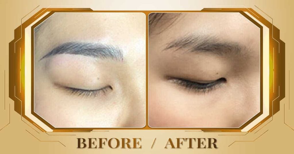 Hình ảnh trước và sau khi xóa xăm lông mày tại Thẩm Mỹ Viện Beryl