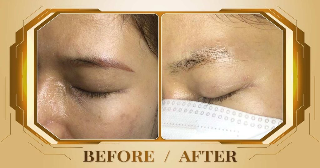 Hình ảnh khách trước và sau khi xóa xăm lông mày tại Thẩm Mỹ Viện Beryl