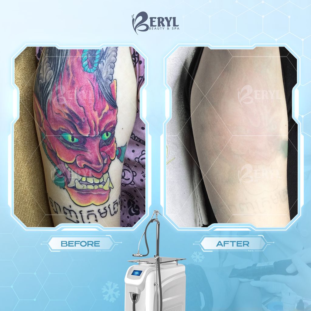 Hình ảnh trước và sau khi xóa xăm tại Beryl