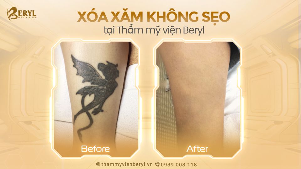 Hình ảnh trước và sau khi xóa hình xăm