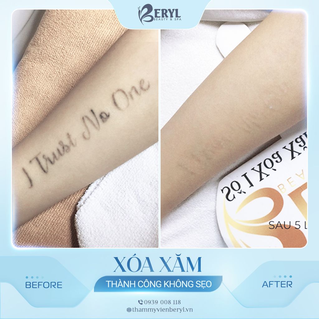 Hình ảnh trước và sau xóa xăm