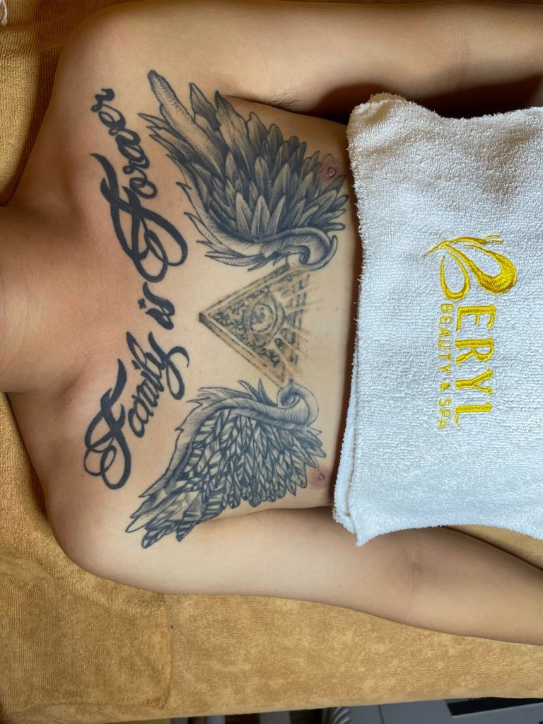 Hình ảnh trước khi xóa hình xăm