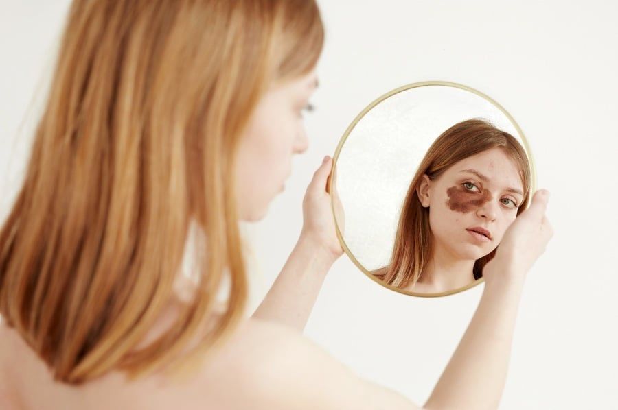 Nỗi lo của người mang vết chàm