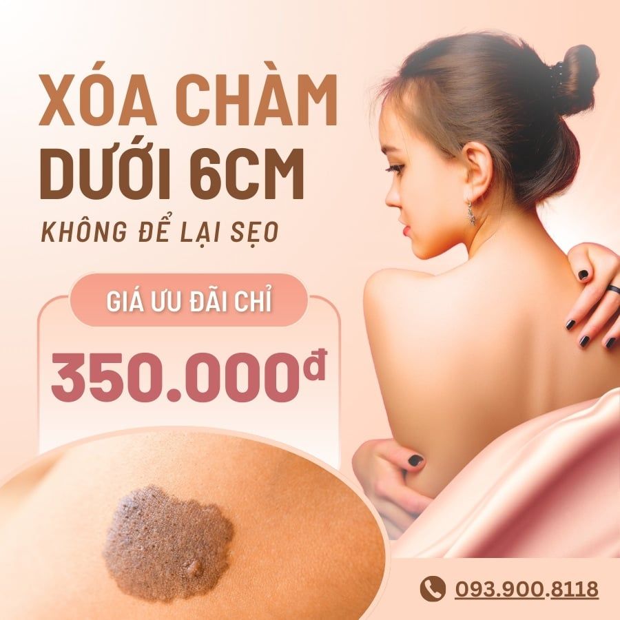 Chi phí xóa vết chàm dưới 6cm