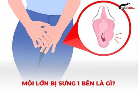 Môi lớn bị sưng 1 bên: Nguyên nhân và khi nào cần đi khám?