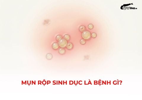 Mụn rộp sinh dục là bệnh gì? Dấu hiệu và biểu hiện, nguyên nhân và cách trị