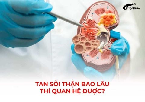Tan sỏi thận bao lâu thì quan hệ được? Thời gian an toàn và những lưu ý cần tránh