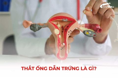 Thắt ống dẫn trứng là gì? Hiểu rõ về cơ chế thực hiện, lợi ích và hiệu quả