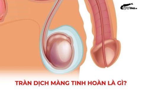 Tràn dịch màng tinh hoàn là gì? Có nguy hiểm không? Cách điều trị