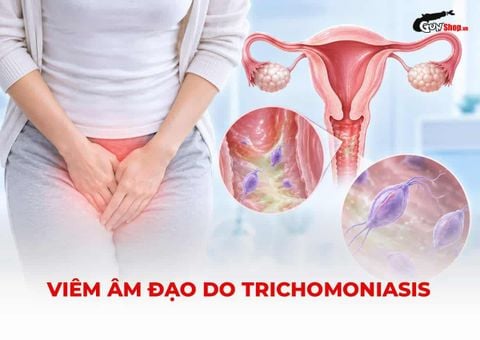 Viêm âm đạo do Trichomoniasis: Dấu hiệu nào dễ bị bỏ qua?