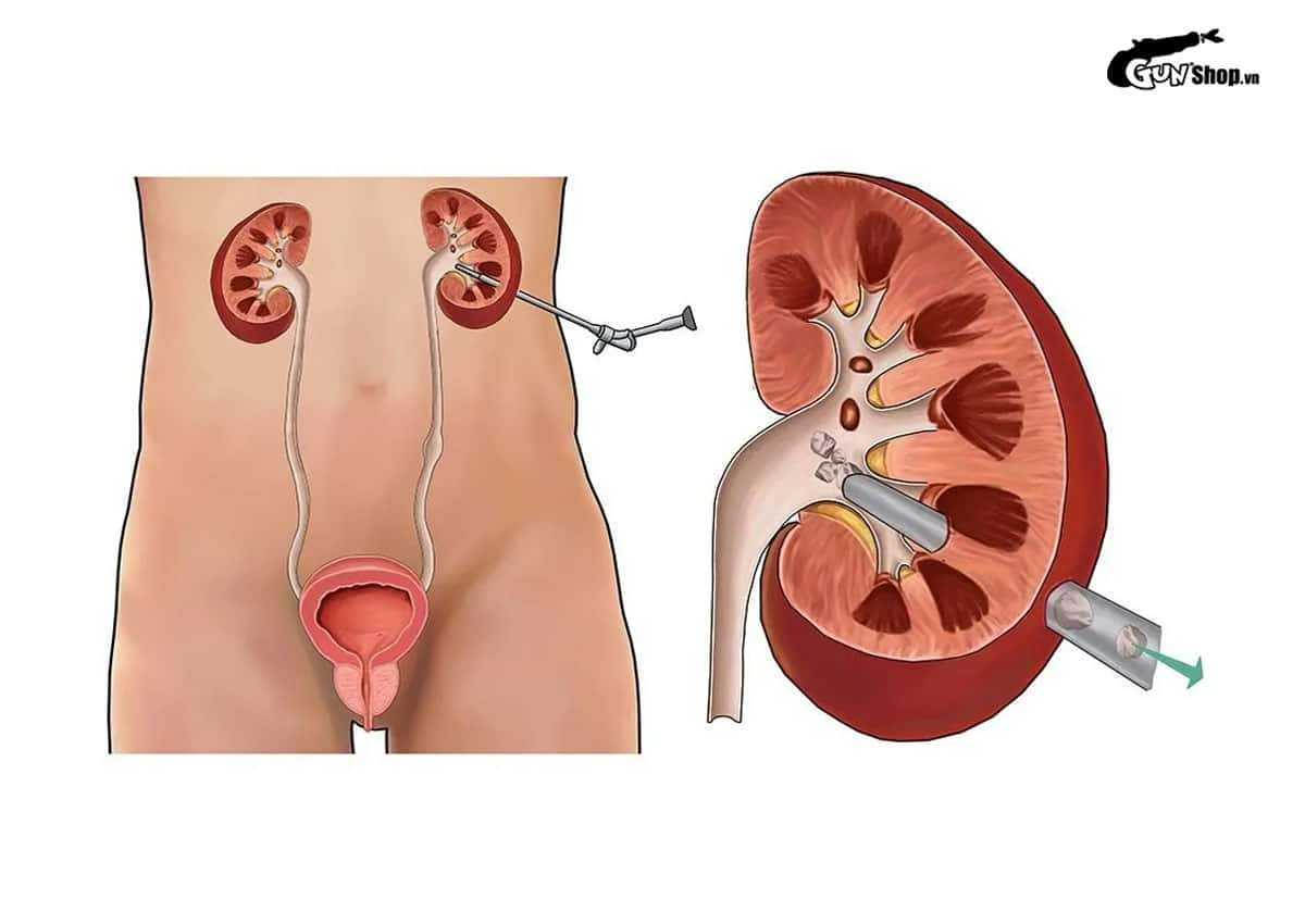 Sau khi mổ sỏi thận bao lâu thì quan hệ lại được?