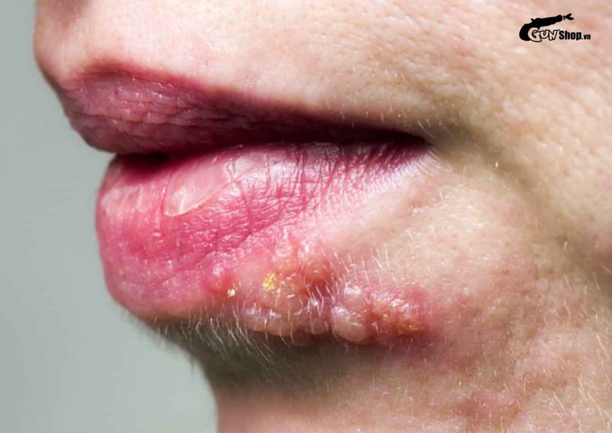 Quan hệ bằng miệng có bị nhiệt miệng không?