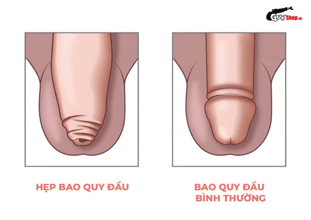 Bao quy đầu là gì?