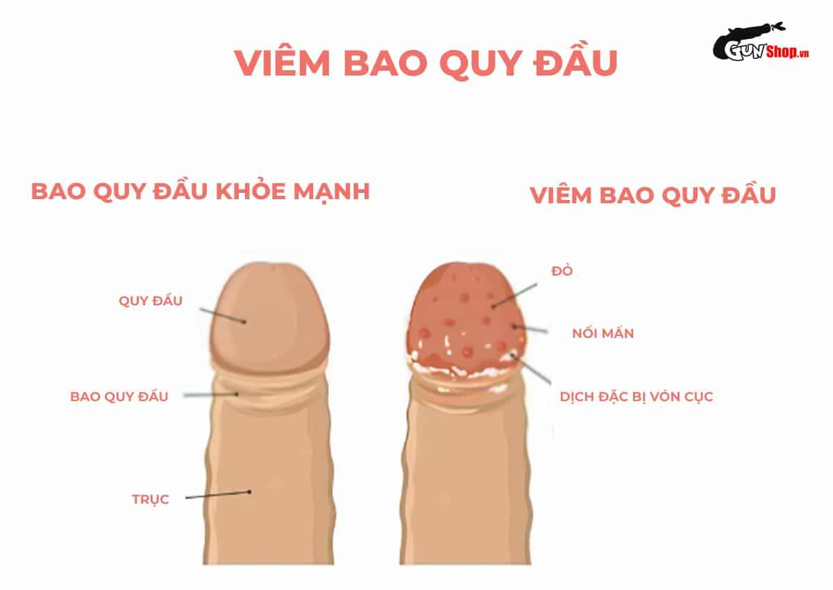 Bao quy đầu là gì?