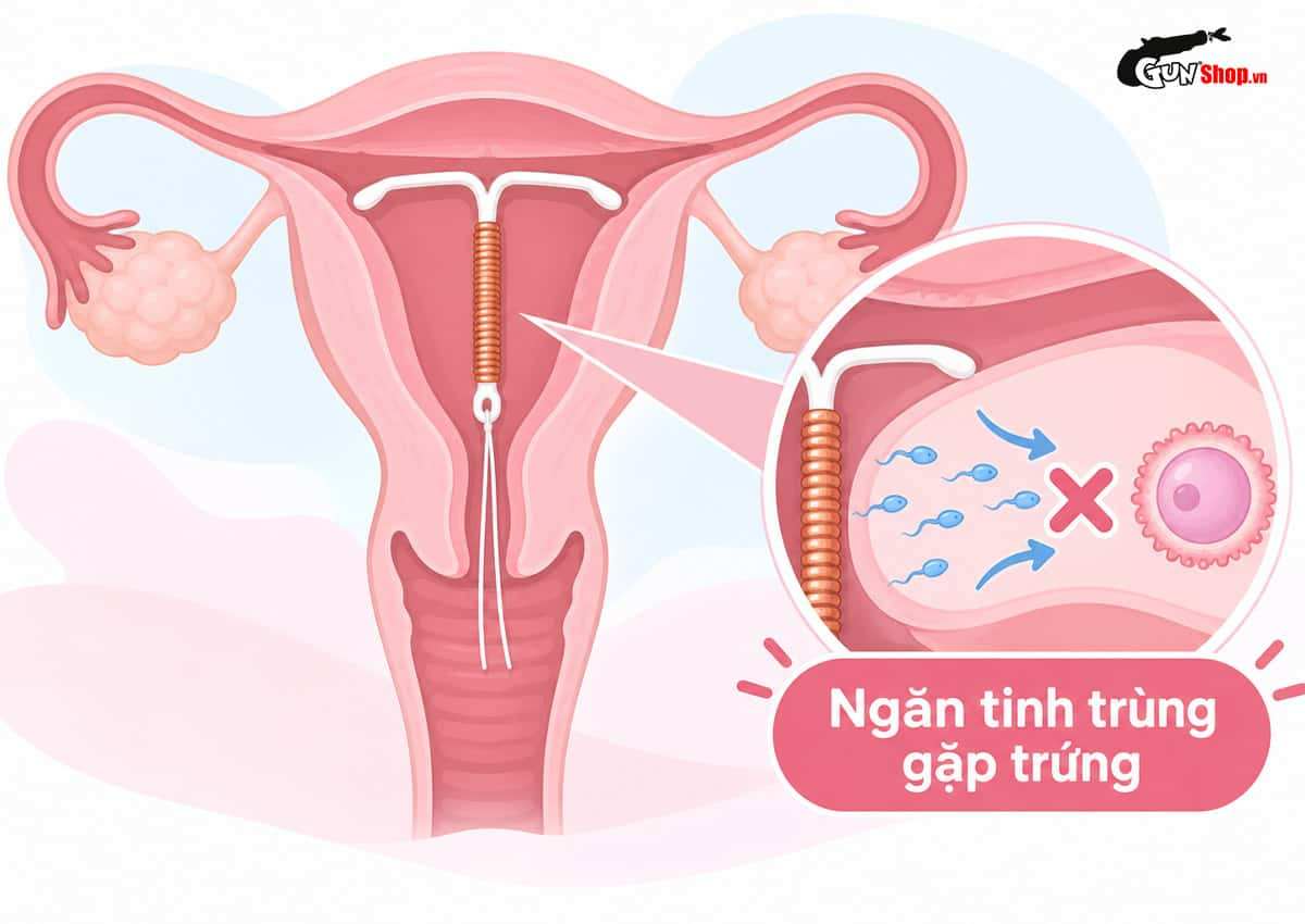 Đặt vòng tránh thai là phương pháp gì?