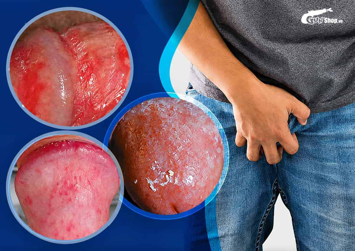 Dương vật bị khô là gì?