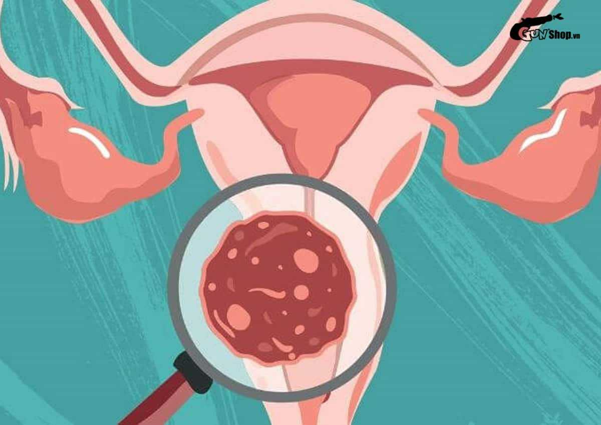 Quan hệ đồng giới có bị nhiễm HPV không?