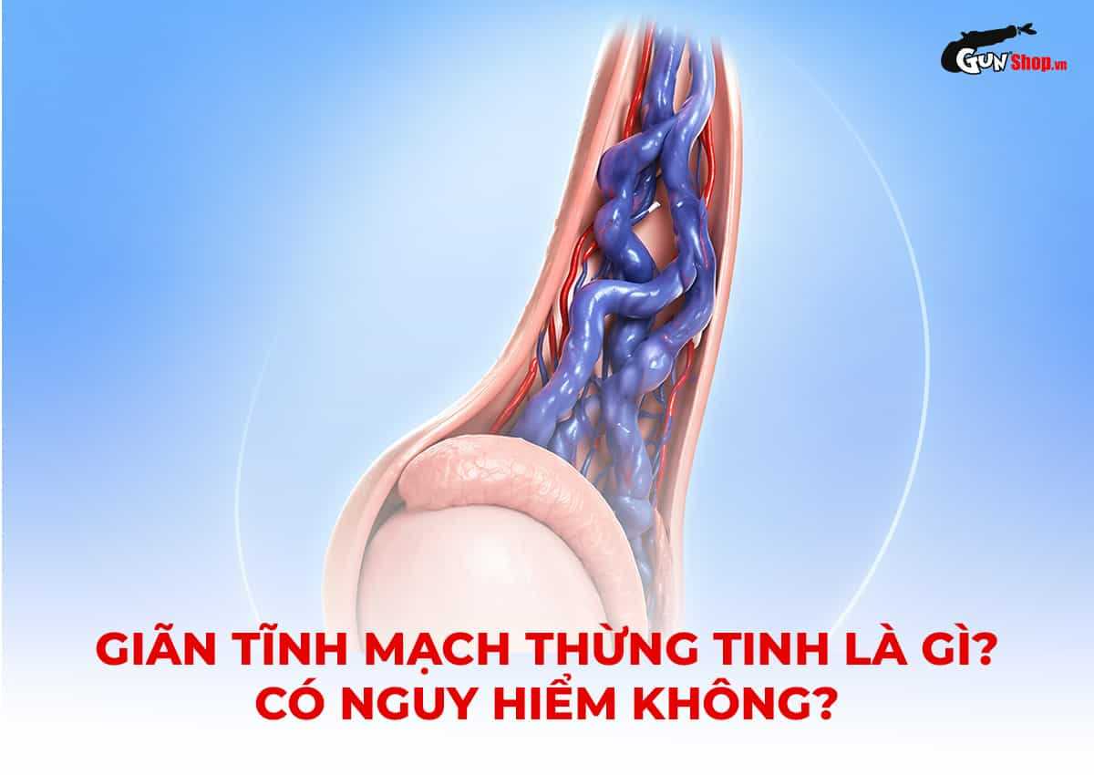 Giãn tĩnh mạch thừng tinh là gì? Có nguy hiểm không? Có chữa khỏi được không?
