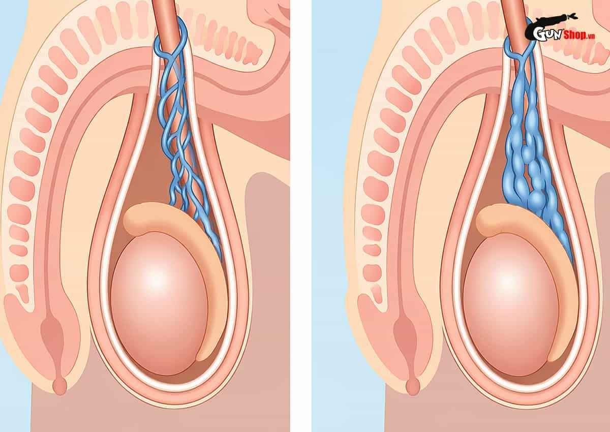 Giãn tĩnh mạch thừng tinh là gì? Có nguy hiểm không? Có chữa khỏi được không?