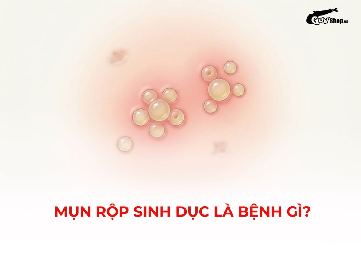 Mụn rộp sinh dục là bệnh gì?