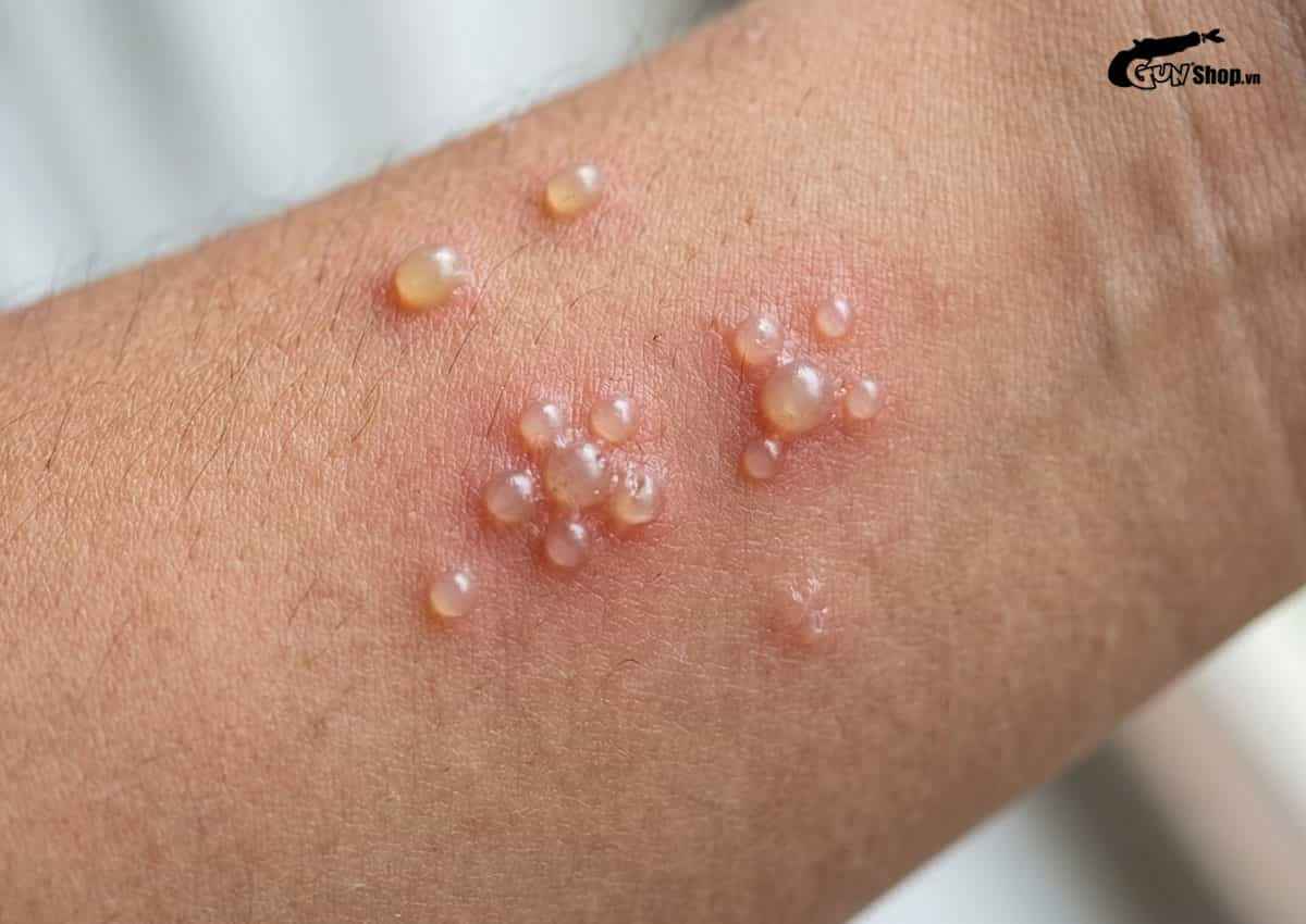 Mụn rộp sinh dục là bệnh gì?