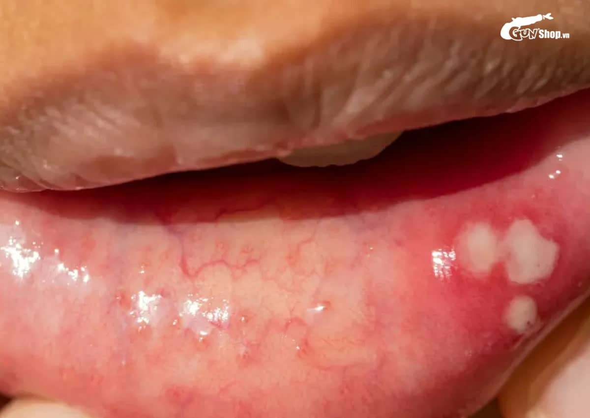 Quan hệ bằng miệng có nguy cơ bị bệnh gì?