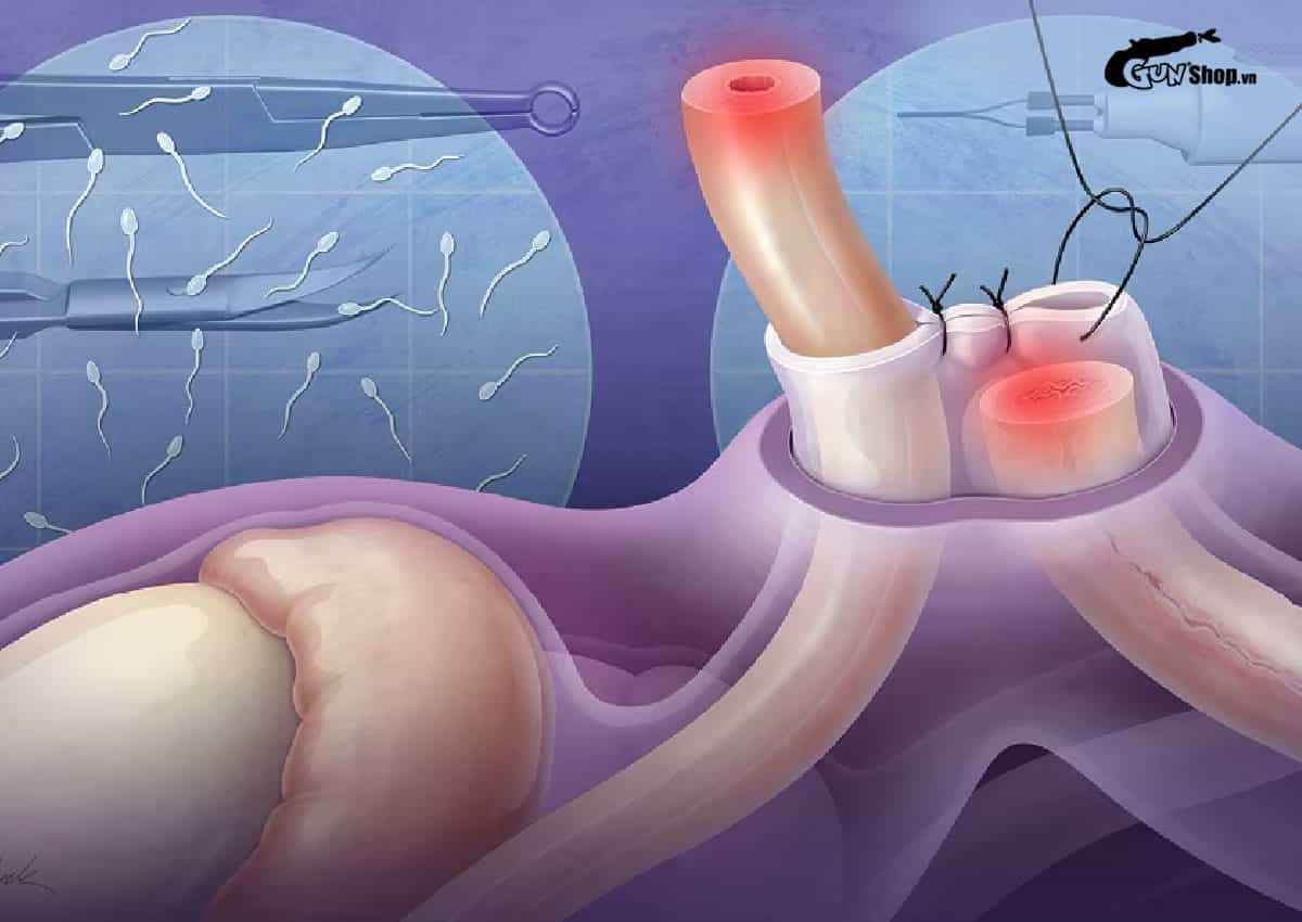 Thắt ống dẫn tinh diễn ra như thế nào?