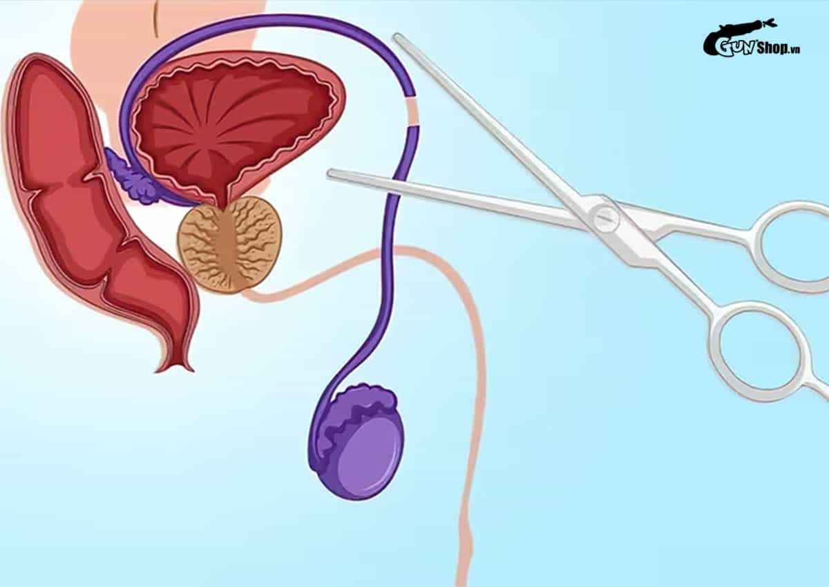 Thắt ống dẫn tinh có đau không?