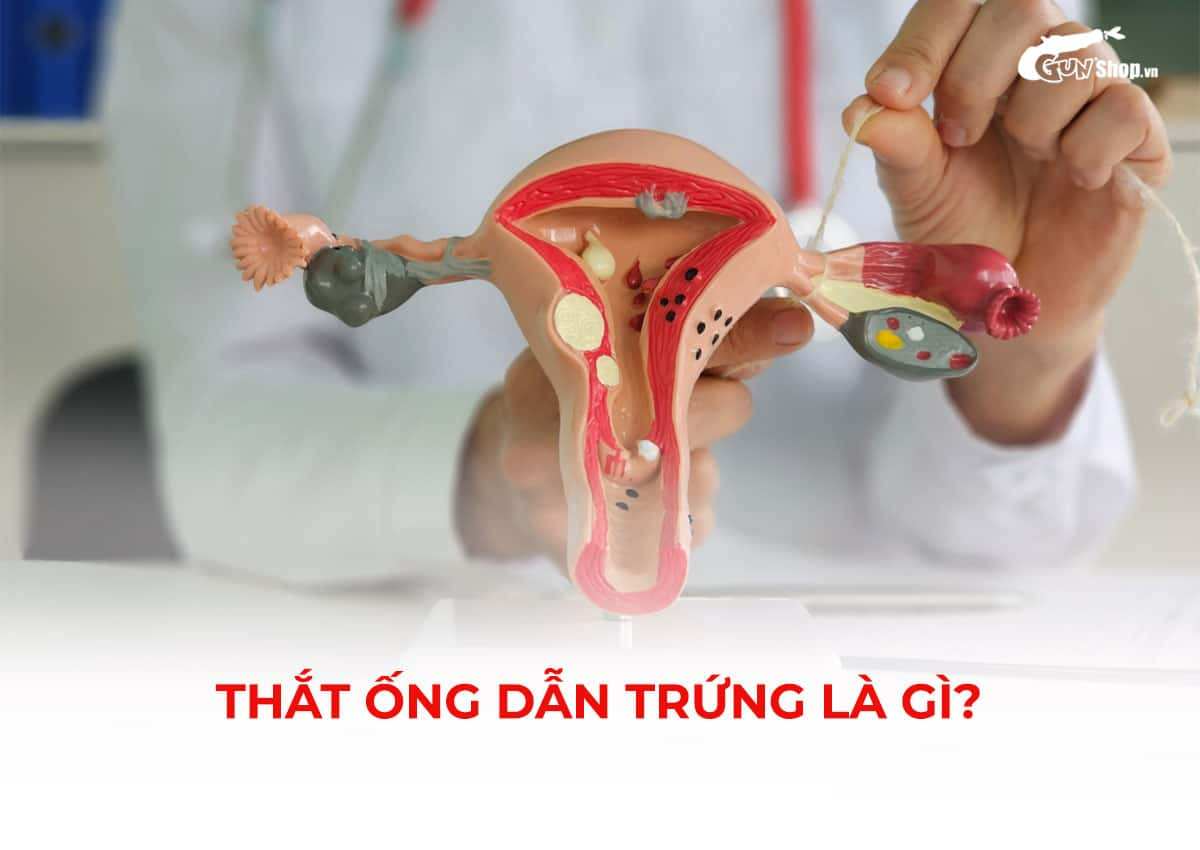 Thắt ống dẫn trứng