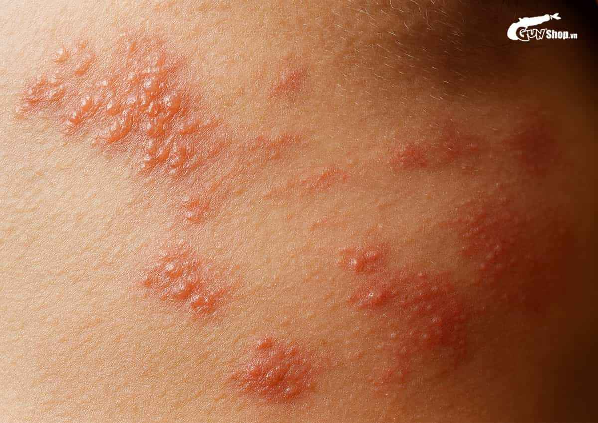 Vi khuẩn Neisseria Gonorrhoeae gây bệnh gì?