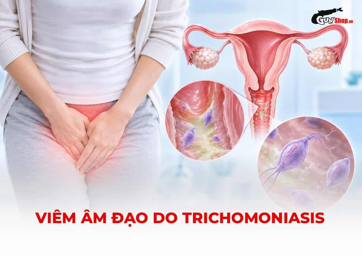 Viêm âm đạo do Trichomoniasis