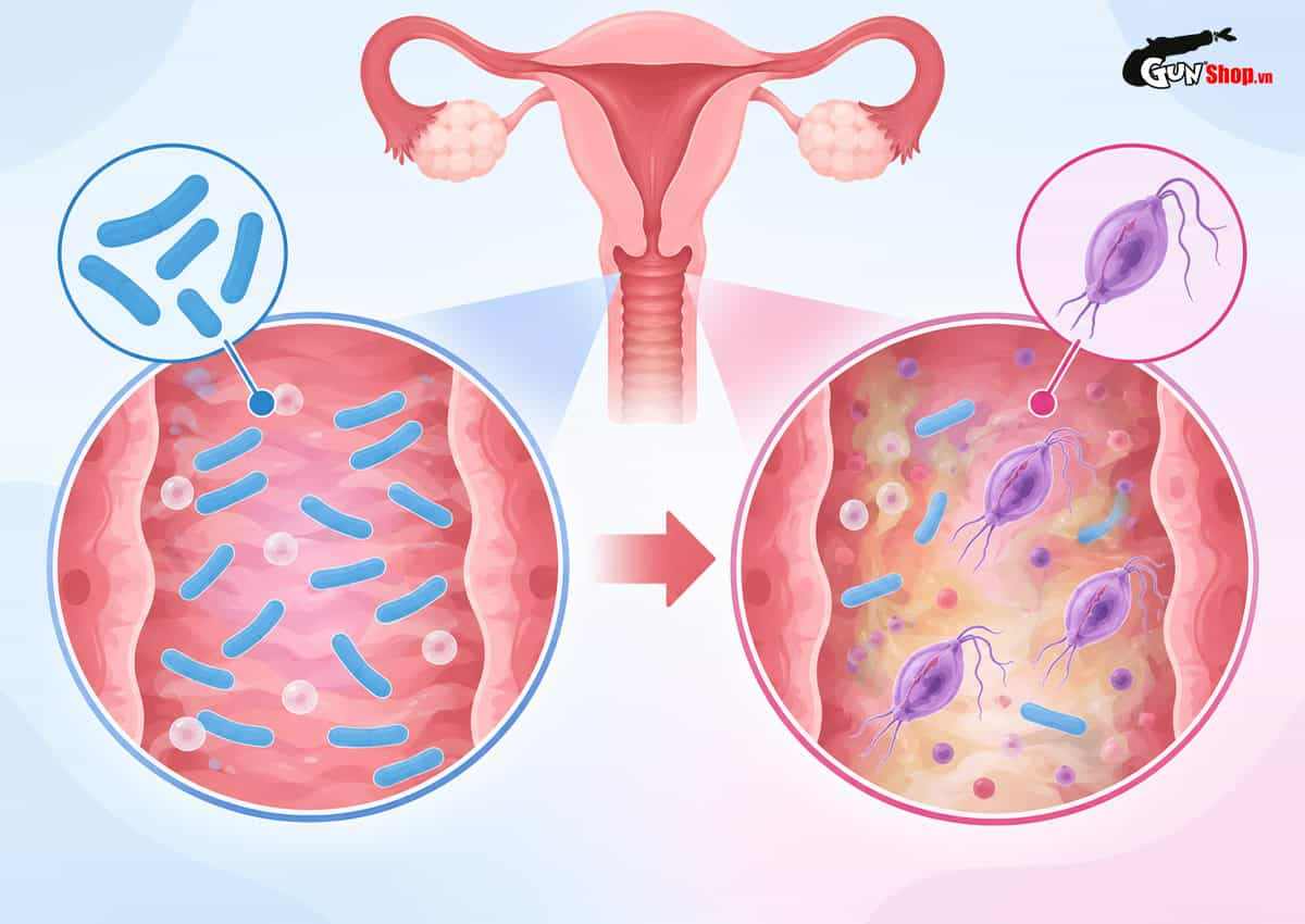Viêm âm đạo do Trichomoniasis