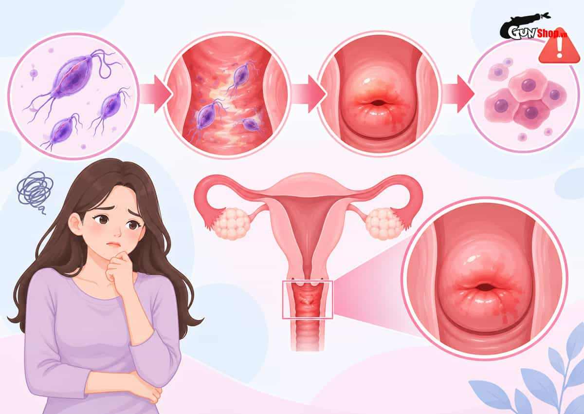 Viêm âm đạo do Trichomoniasis