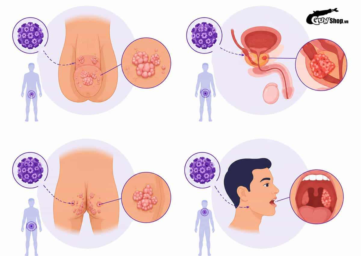 Virus HPV gây bệnh gì ở nam giới?