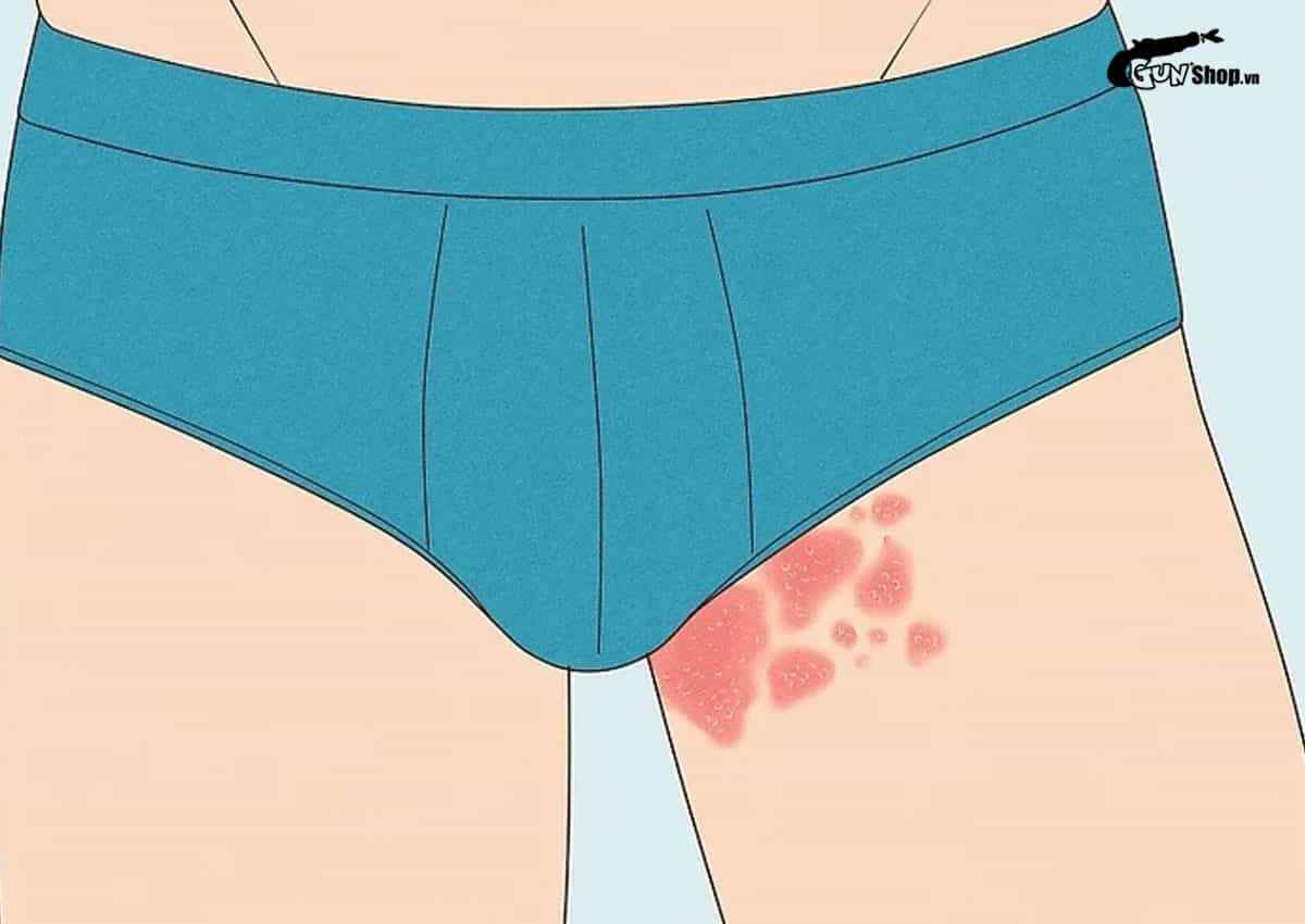 Virus HPV gây bệnh gì ở nam giới?