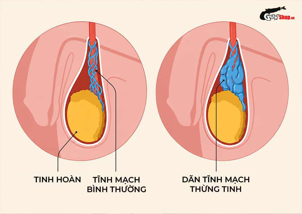 Xuất tinh ra máu là gì? Nguyên nhân và dấu hiệu cần đi viện gấp!