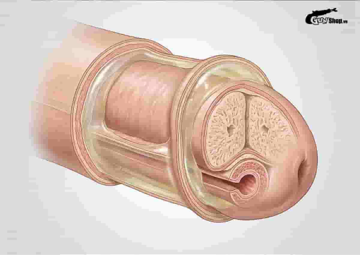 Bao quy đầu bị sưng phồng lên như cục mỡ