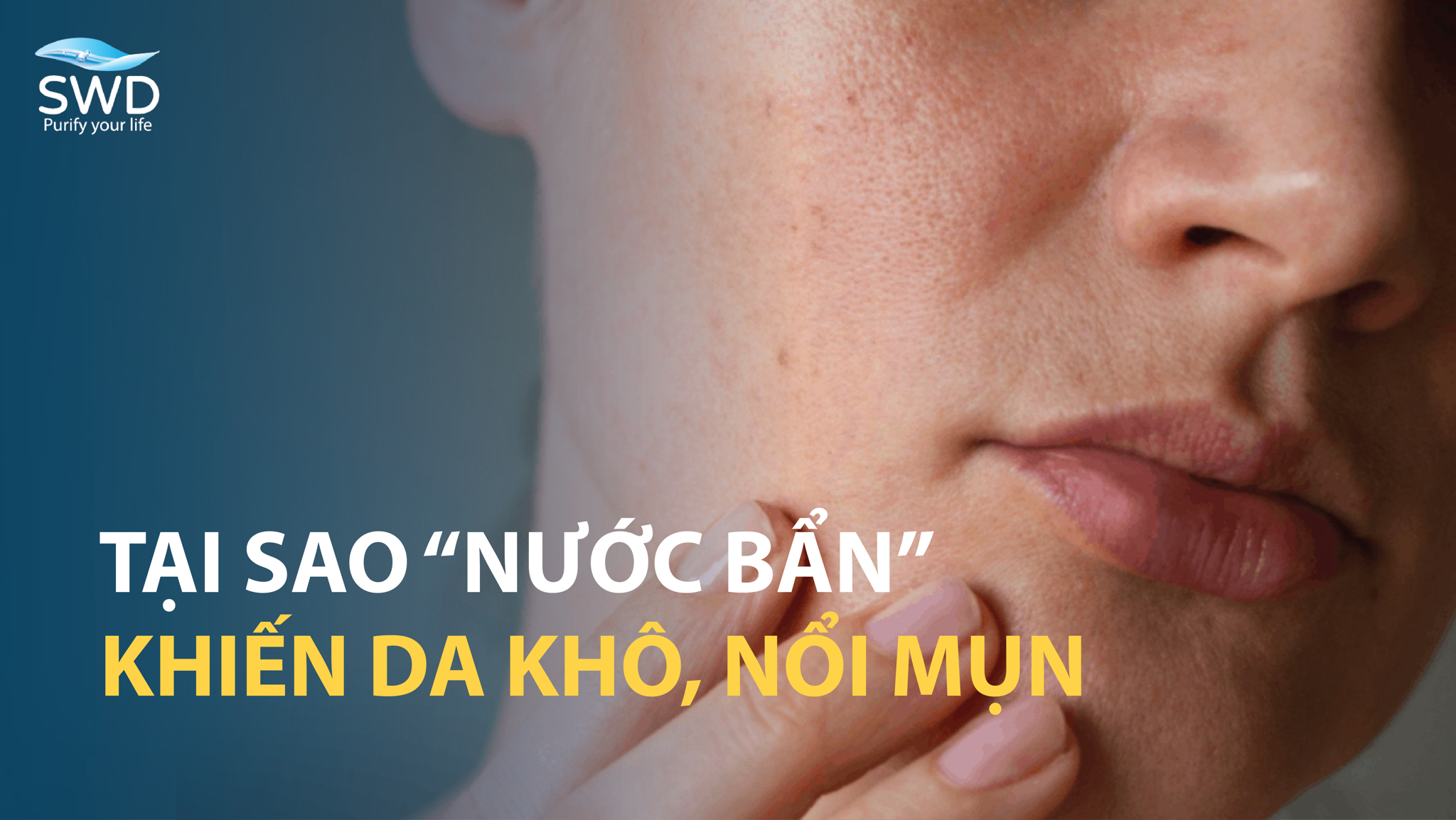 TẠI SAO NƯỚC BẨN KHIẾN DA KHÔ, NỔI MỤN?
