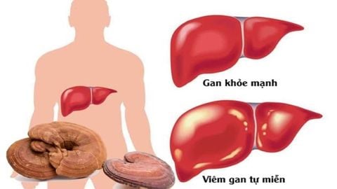 Tác dụng của nấm linh chi trong điều trị bệnh viêm gan