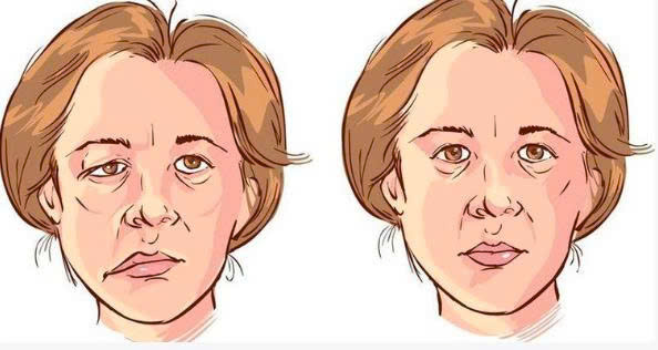 LIỆT DÂY THẦN KINH MẶT