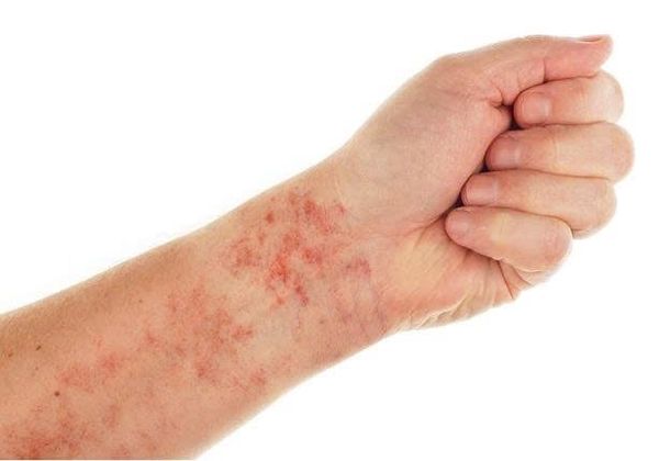 XUẤT HUYẾT DƯỚI DA: NHỮNG CẢNH BÁO KHÔNG NÊN BỎ QUA