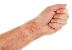 XUẤT HUYẾT DƯỚI DA: NHỮNG CẢNH BÁO KHÔNG NÊN BỎ QUA