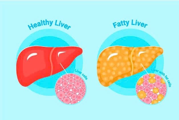 BỆNH GAN NHIỄM MỠ