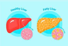 BỆNH GAN NHIỄM MỠ