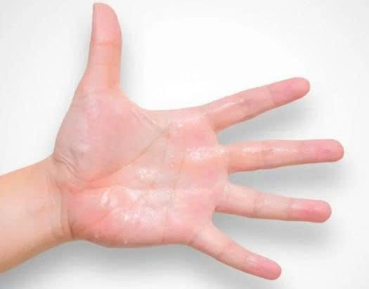 NGUYÊN NHÂN GÂY RA MỒ HÔI LÒNG BÀN TAY
